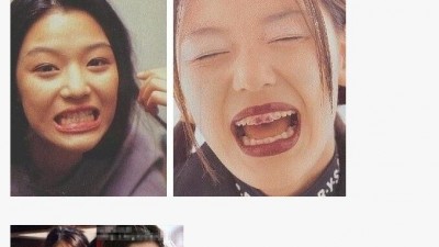 연예인들이 많이 한다는 시술.