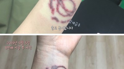 타투 4년 동안 지운 후기