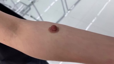 슬픈 적곽지 이동증후근